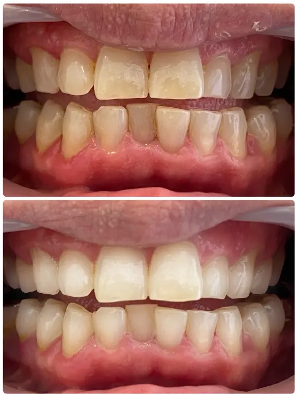 ホワイトニングの before after画像