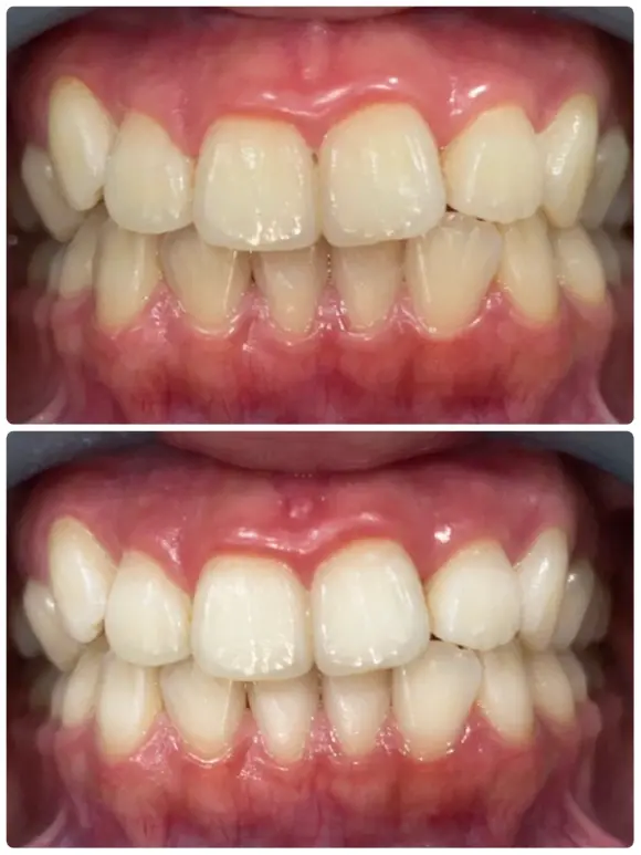 ホワイトニングの before after画像